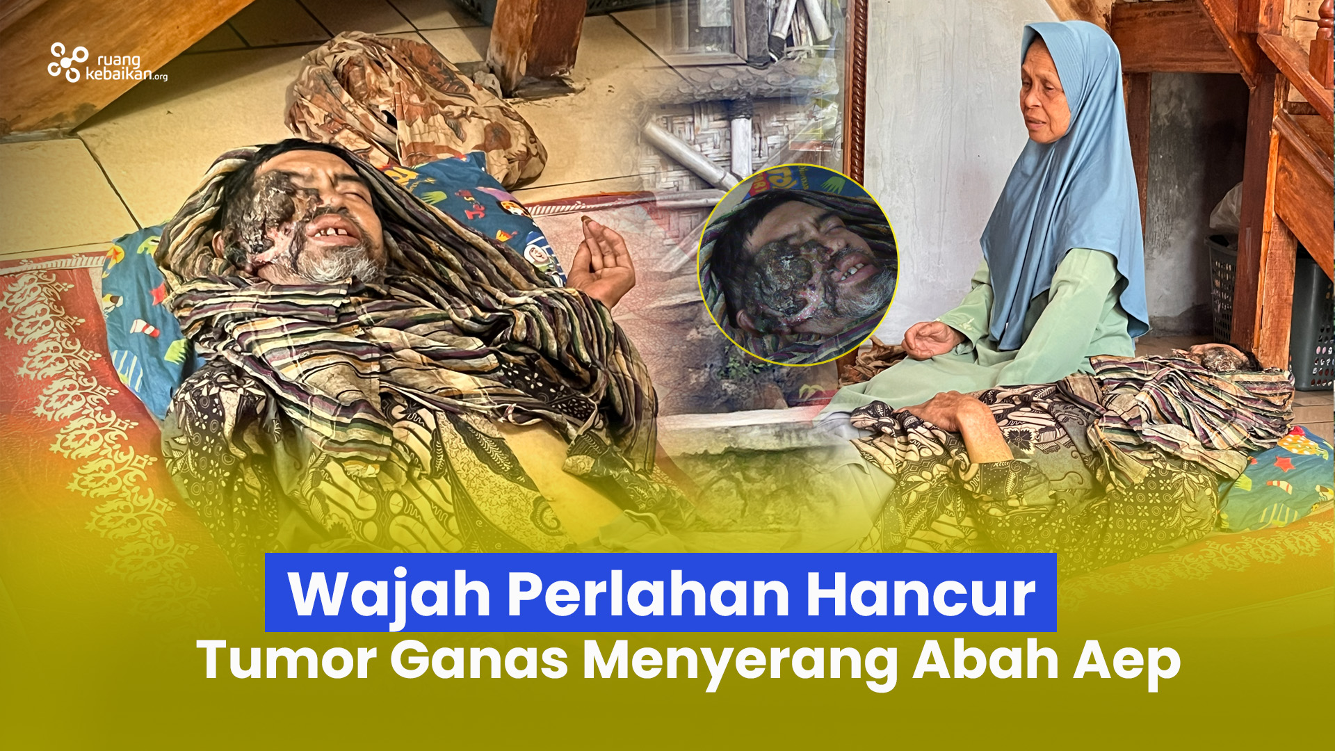 Setengah Wajah Rusak , Tumor Ganas menyerang wajah bah Aep